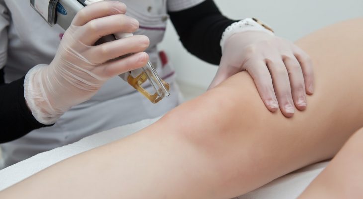 depilacja laserowa